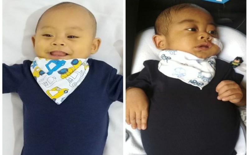  Mari Bantu Syadzili, Bayi 8 Bulan Asal Lampung Derita Atresia Bilier